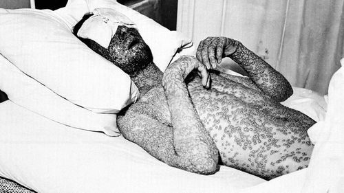 A man, who has contracted small pox, is shown with a formation of scar-producing pustules on his body on Nov. 1, 1941. The New York State Board of Health anti-disease campaign used this image in 1941 to encourage the public to vaccinate in New York and other states with the caption, "This man was never vaccinated against smallpox." (AAP)