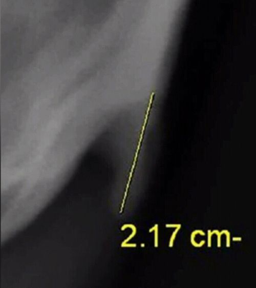 190619 Health news Australia mobile phone use young people research horn bone spur formations