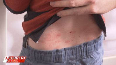Emma Fisher said her family spends thousands of dollars each year on creams and medication for her son's eczema.