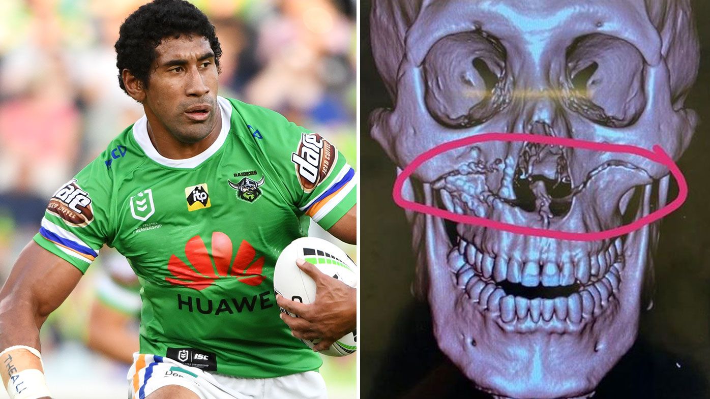 Iosia Soliola and scans of his facial fracture  