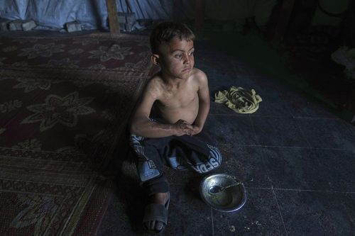 Abdullah Ashour, 7, who suffers from burns caused by hot food, sits beside his empty plate after a meal at his family's tent in a camp set up at a former UNRWA school in central Gaza City, Saturday, May 24, 2025. (AP Photo/Jehad Alshrafi)