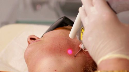 As the cosmetic laser industry booms, thousands are chasing perfect skin with quick and cheap treatment. But dermatologists are concerned the largely unregulated procedure is covering up the signs of something more sinister.