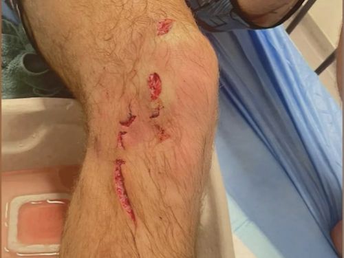 A man has been bitten on the leg by a saltwater crocodile near a popular remote campground in the WA Kimberley.  Kyle Hutchinson was out walking with friends when he came face to face with the predator.