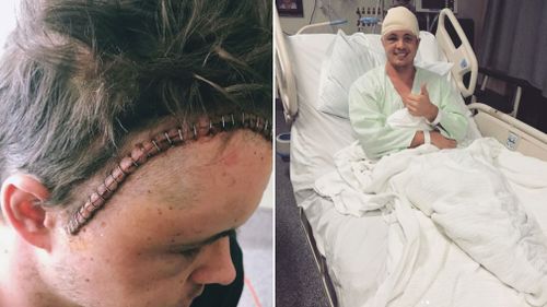 Ruffo's post-surgery scar. (Instagram)