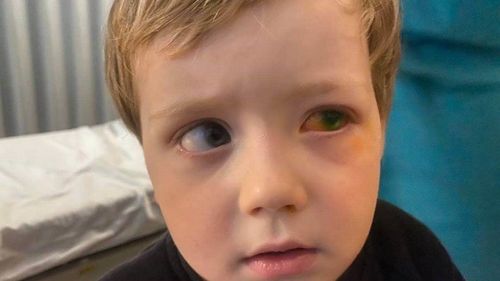 James Lapthorn, 3, received chemical burns in his eye from using a hand sanitiser foot pump.