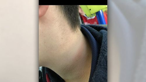Marks on one of the victims' neck.