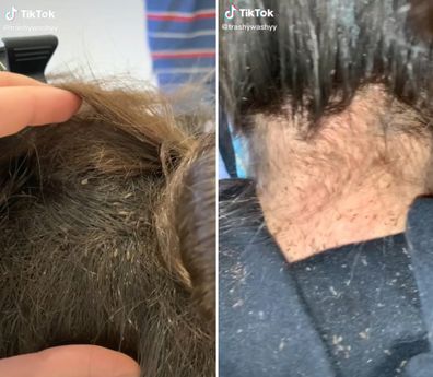 TikTok lice expert shares videos of her treatments. 
