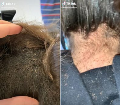 Head lice infestation video will certainly make your skin crawl