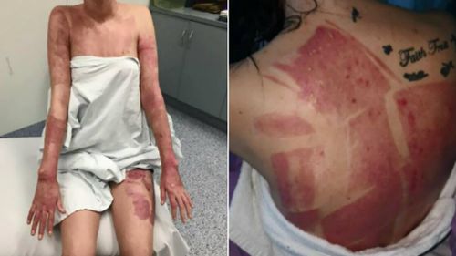 Kyesha Finemore woke up in hospital with severe burns. Pictures: Supplied