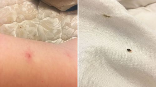 A bed bug bite a Redan Apartment customer said she got inside one of their apartments and one of the bugs pictured.