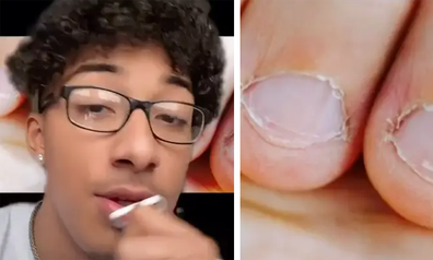 Videos show disgusting reasons you should stop biting your nails