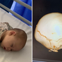 Baby fall warning after six-month-old suffers fractured skull