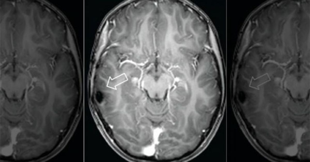 Симптомы опухоли головного мозга у кота
