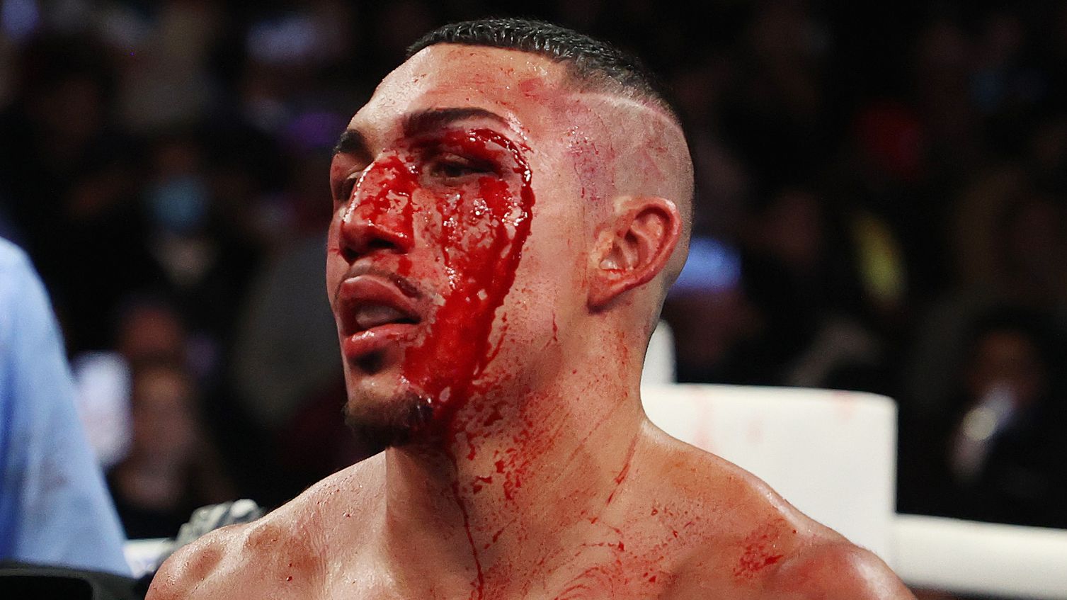 Teofimo Lopez stands bloodied after his bout against George Kambosos.