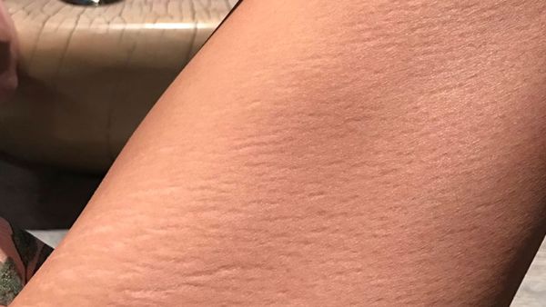 Chrissy teigen stretch marks