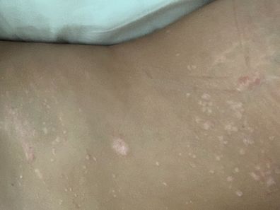 January 2019, Ashley's psoriasis got bad all over her torso.
