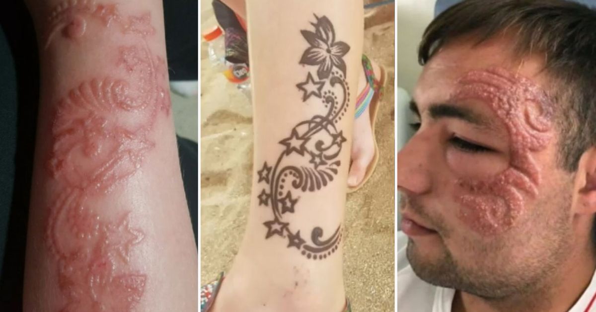 Dangerous 'Black Henna' Tattoos Leaving Bali Tourists With Permanent Scars