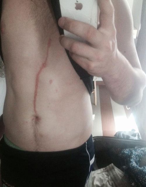 The scar was up to 30cm long after the small tropical spider burrowed into his stomach. (Picture: Facebook)