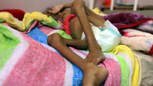 A malnourished child in a Yemen hospital.