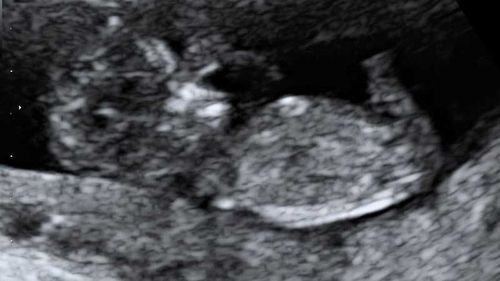 'It's time': Pregnant Melbourne mums call for ban on partners at ultrasounds to be scrapped 