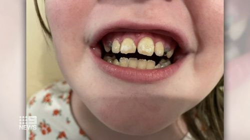 Ryker, huit ans, a eu besoin d'une chirurgie dentaire pendant trois ans.