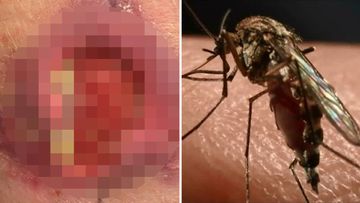 Buruli Ulcer flesh eating disease mosquito