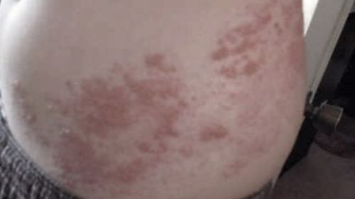 The virus can cause a rash and severe pain in the lower back. Picture: 9NEWS