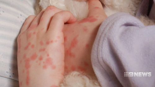 Meningococcal cases doubled in 2017. (9NEWS)