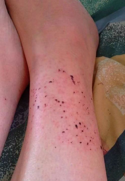 "It was like tiny pin holes everywhere in my legs," Ms Shrimpton said. (Supplied)