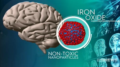 The team are using nanoparticles made of iron oxide with special magnetic properties and coated with an antibody to seek out and target the plaques in the brain.