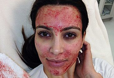 What type of blood is reinjected into a client in a vampire facial?