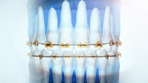 The technology works by attaching triangular brackets to the teeth, with a flexible wire system used to move the crown and root simultaneously. (9NEWS)