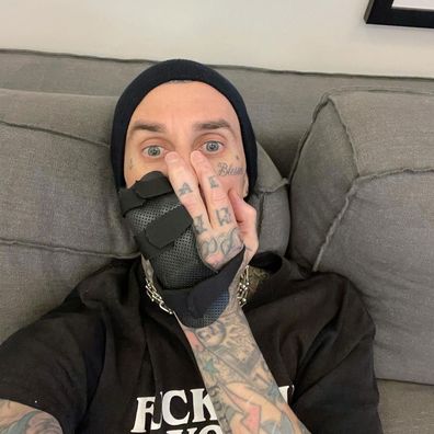 Travis Barker reveals finger injury after dislocating it and tearing the ligaments during rehearsals.