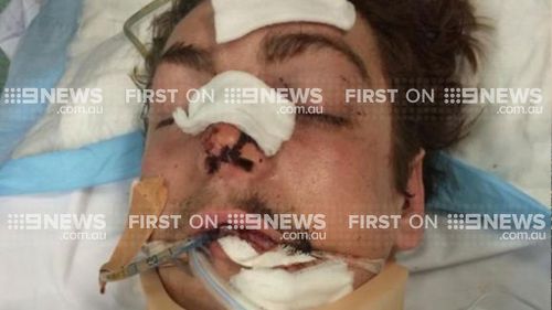 Bondi 'one-punch' victim leaves hospital only a day after attack
