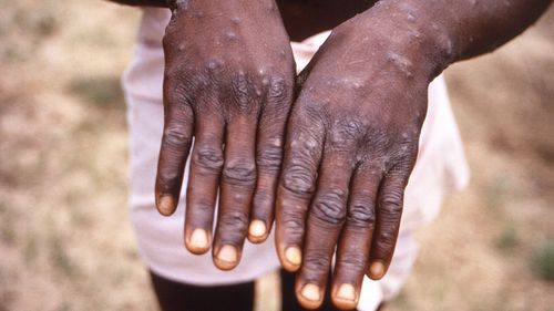 Monkeypox is traditionally only found in Africa, or in people who have recently returned from the continent.