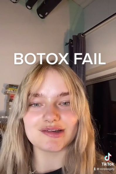 Botox fail in face