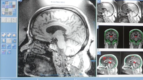 Pills used for sleep now the focus of new trial to boost memory and thinking