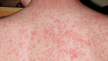 Victoria records first case of measles in more than two years
