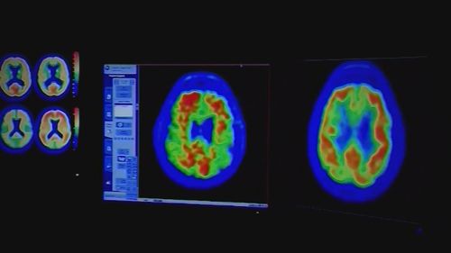 Gli adulti tra i 60 e i 69 anni che hanno riferito di aver fatto brutti sogni hanno quattro volte più probabilità di sviluppare demenza.