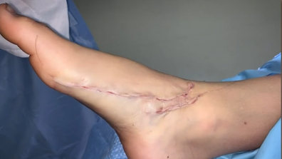 The scar on Jackson Bartlett's foot after the shark attack. 