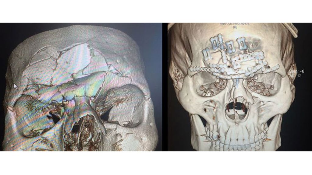 MMA fighter Evangelista Santos gets caved in skull fixed up