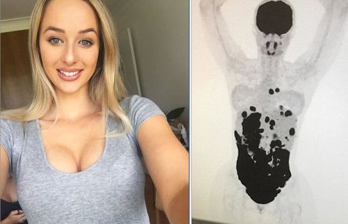 A PET scan showed that Georgia's body had been riddled by Burkitt Lymphoma that affected all of the organs in her abdomen (Instagram).