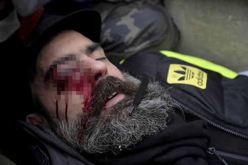 French police are investigating how a prominent yellow vest protester, Jerome Rodrigues, suffered an eye injury in Paris.