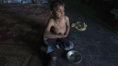 Abdullah Ashour, 7, who suffers from burns caused by hot food, sits beside his empty plate after a meal at his family's tent in a camp set up at a former UNRWA school in central Gaza City, Saturday, May 24, 2025. (AP Photo/Jehad Alshrafi)