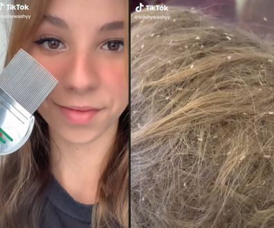 TikTok lice expert shares videos of her treatments. 