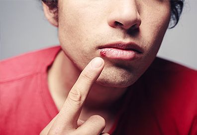 Boy with cold sore