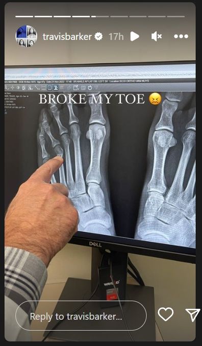 Travis Barker revela que quebrou o dedo do pé por alguns dias.