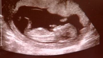 Zoe&#x27;s Law - The new legislation will see jail sentences for criminals who cause the death of an unborn child.