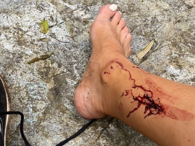 Madeleine West: Former Neighbours star shows off gruesome injury after hike