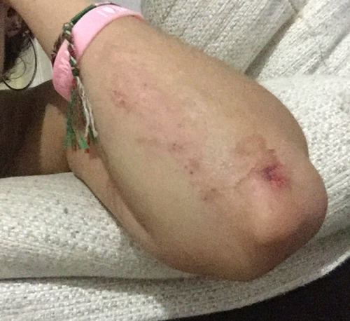 Locals posted to social media scrapes and bruises they received while sliding down the Estepona chute.